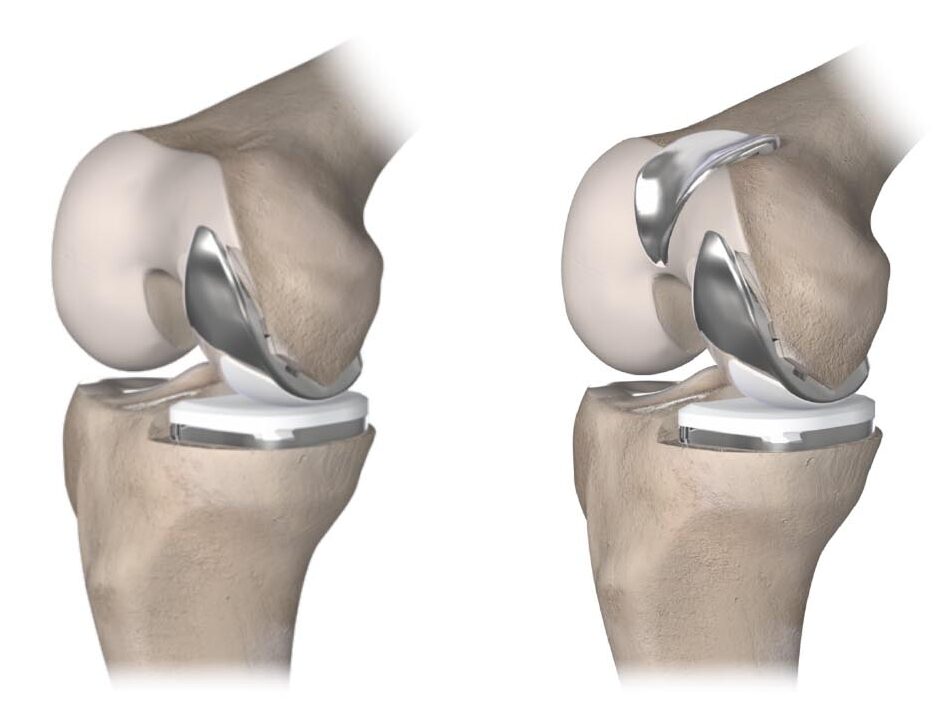 Spire Hospital Southampton offer more options for knee surgery